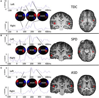 Magnetoencephalographic Imaging of Auditory and Somatosensory Cortical Responses in Children with Autism and Sensory Processing Dysfunction